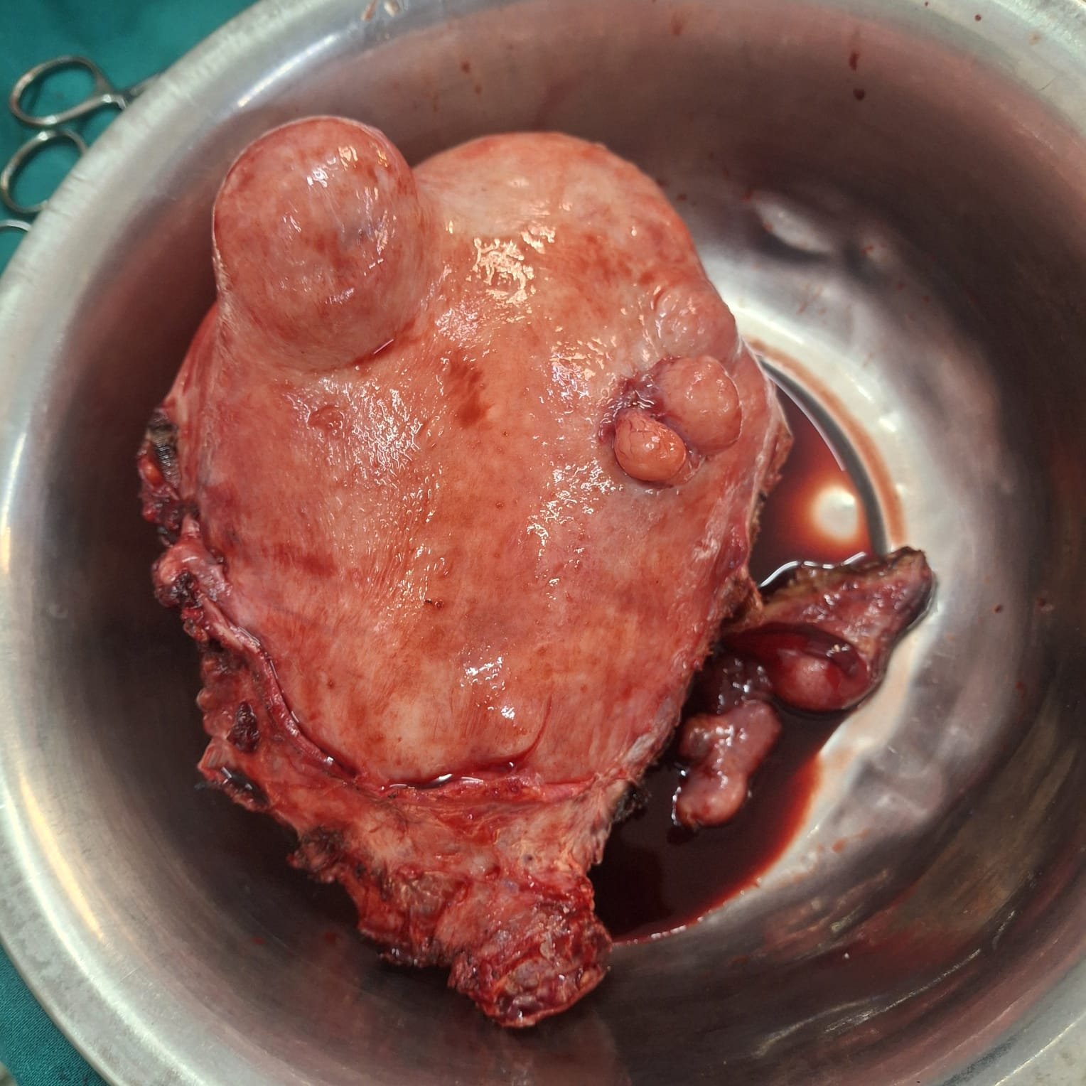 Hysterectomy (uterus removal)